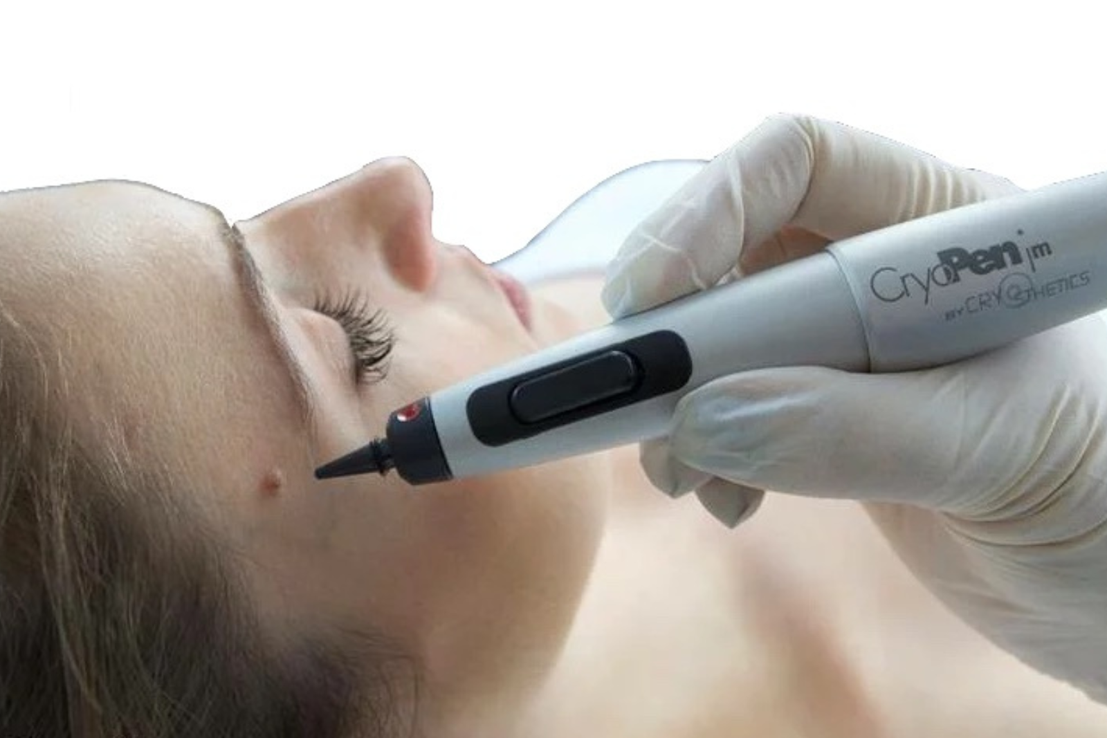 cryopen treatment