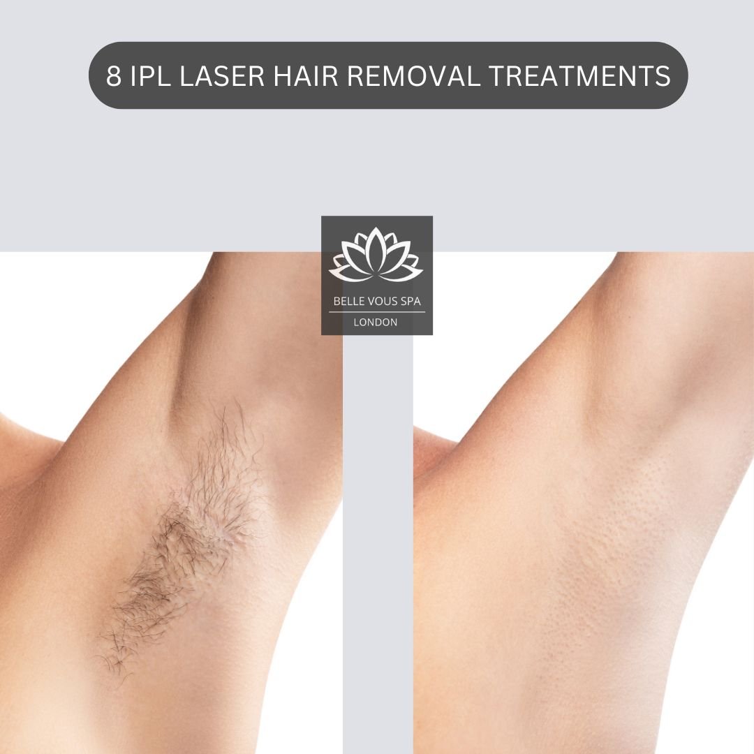 Laser hair removal