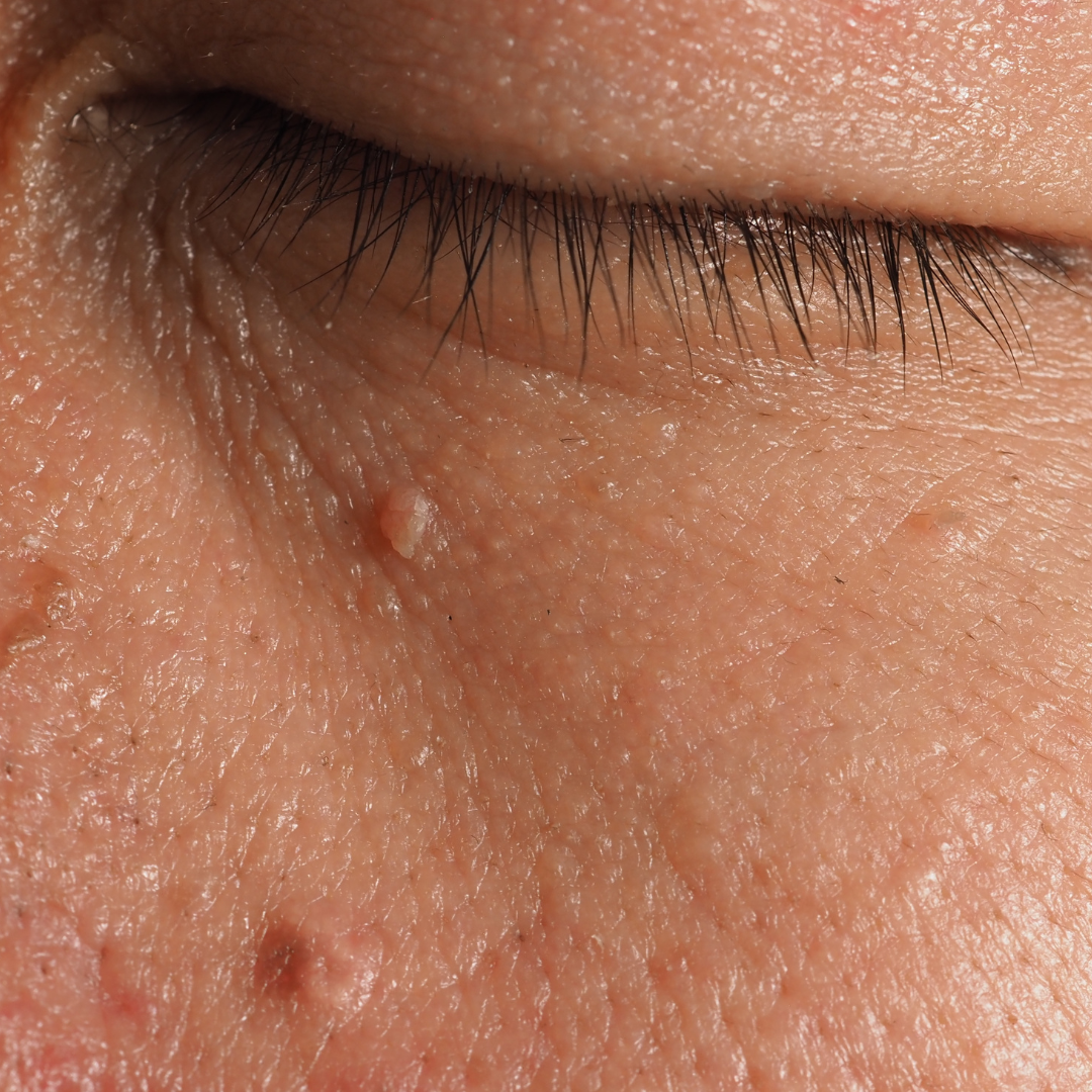 cryotherapy skin tags