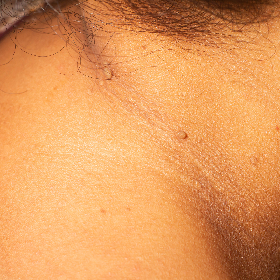 cryotherapy skin tags
