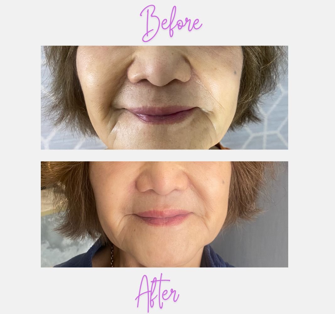Marionette lines & nasolabial Fold Fillers