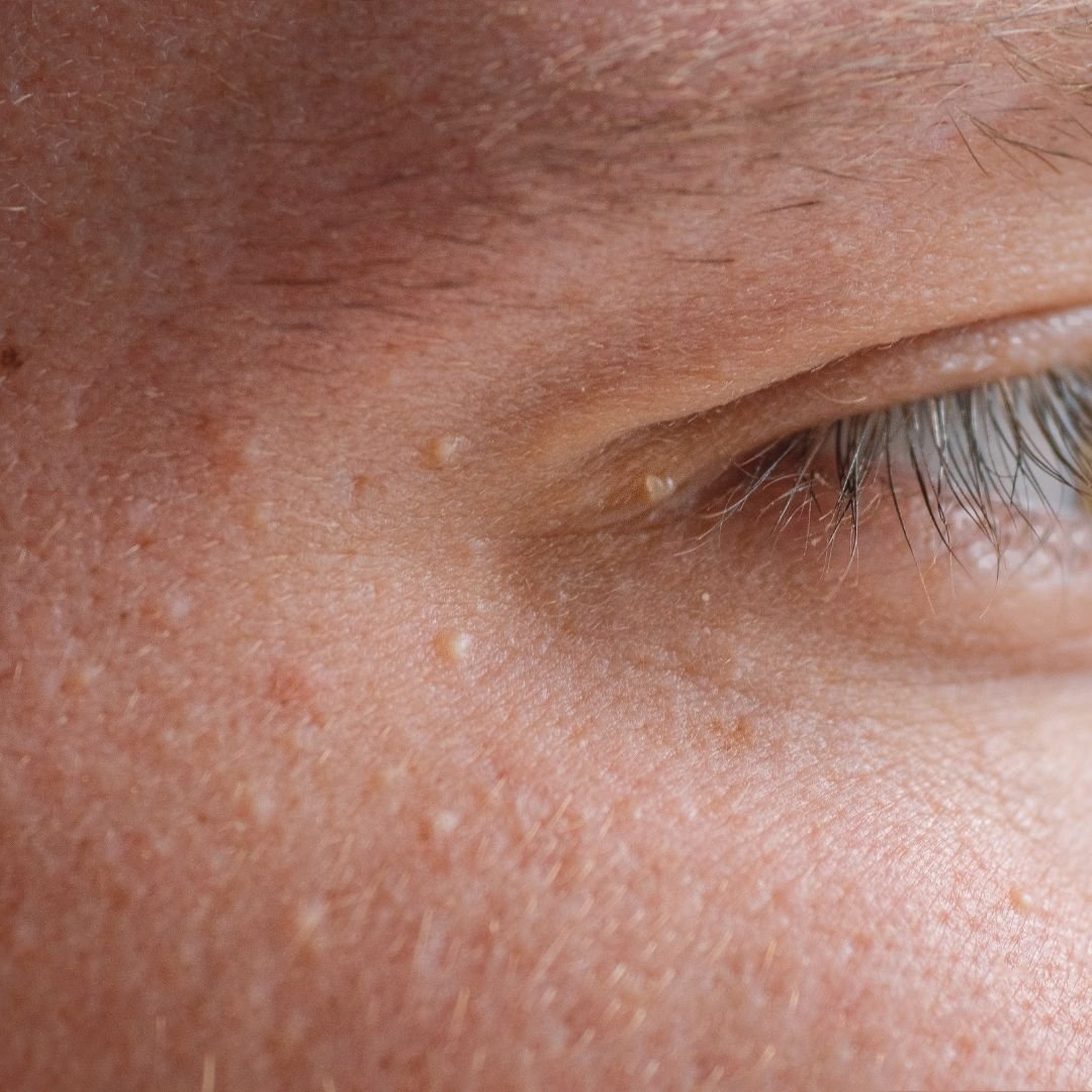 cryotherapy milia