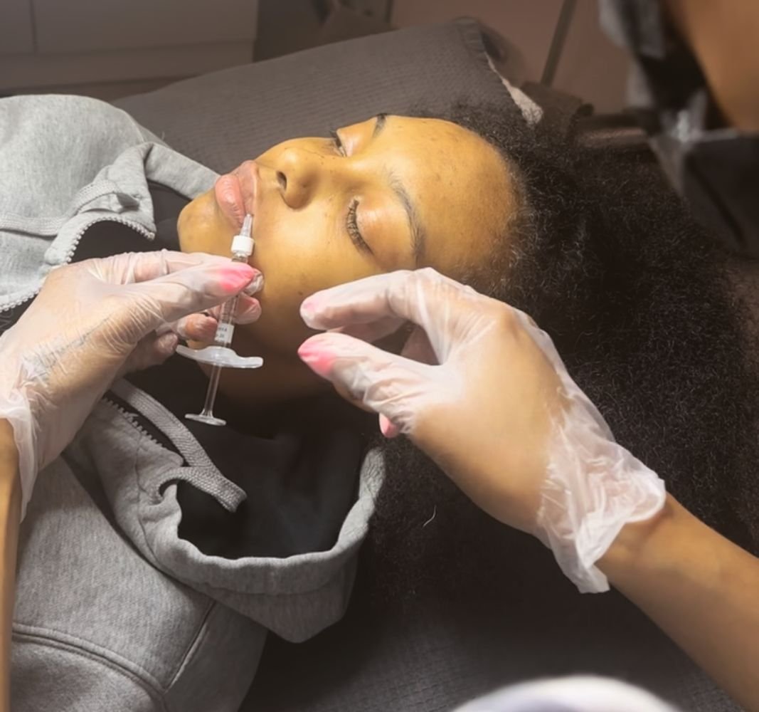 lip filler