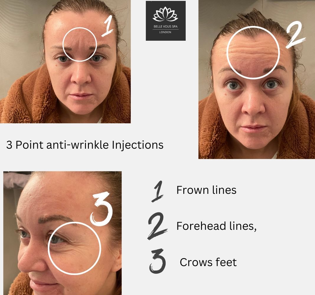 botox