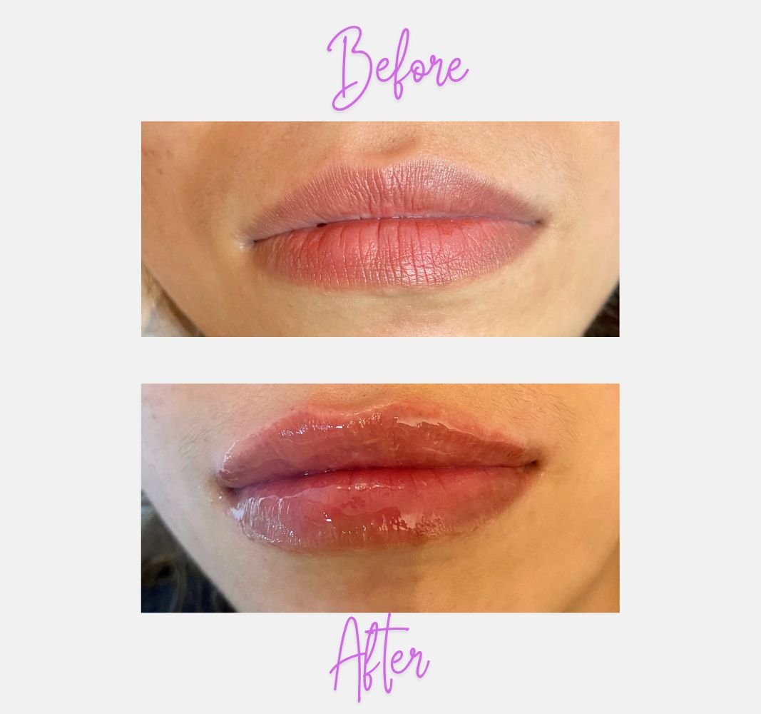 Lip Fillers