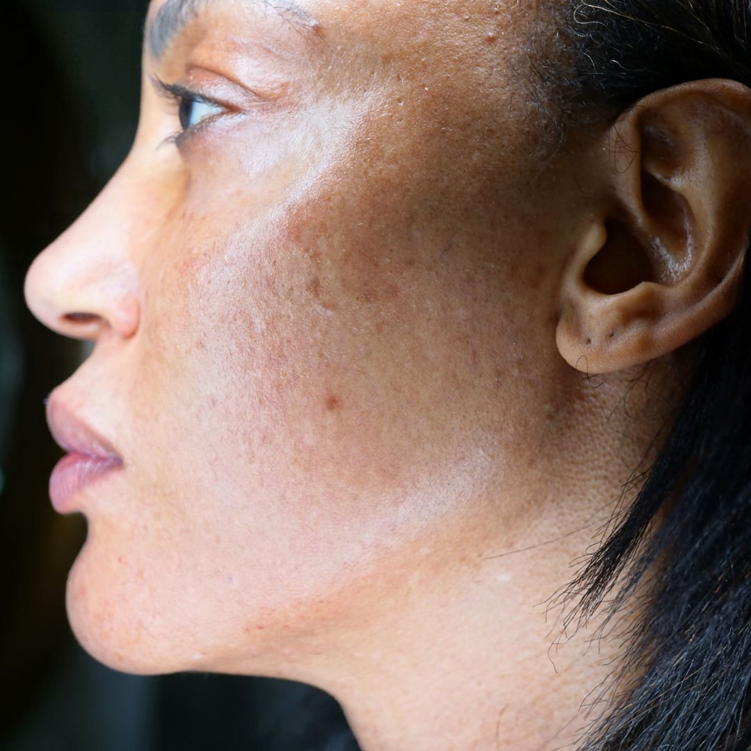 Microdermabrasion Facials