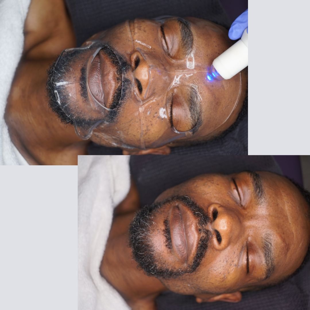 Microdermabrasion Facials
