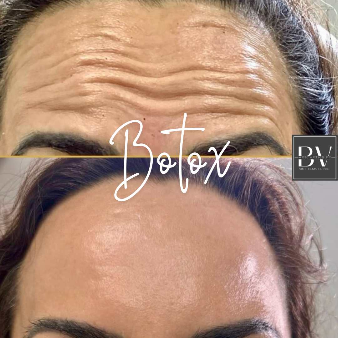 Botox