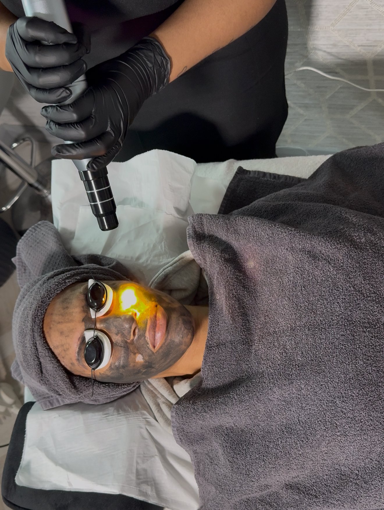 carbon laser facial