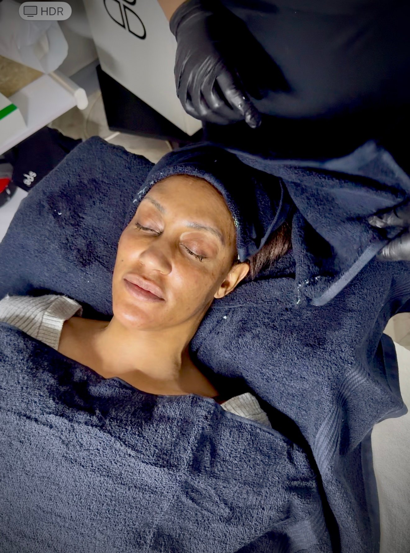 Glowing skin after laser facial