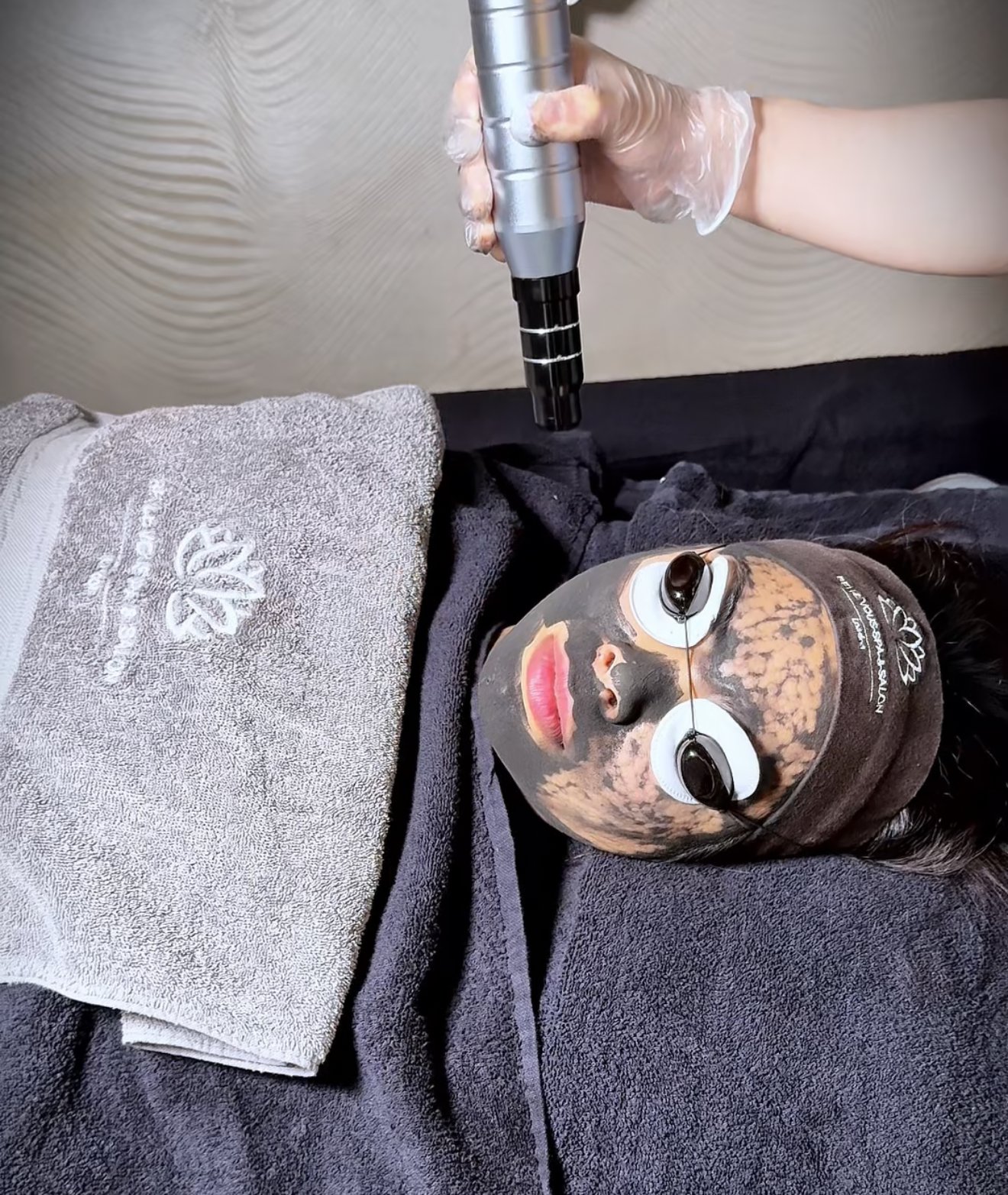 carbon laser facial