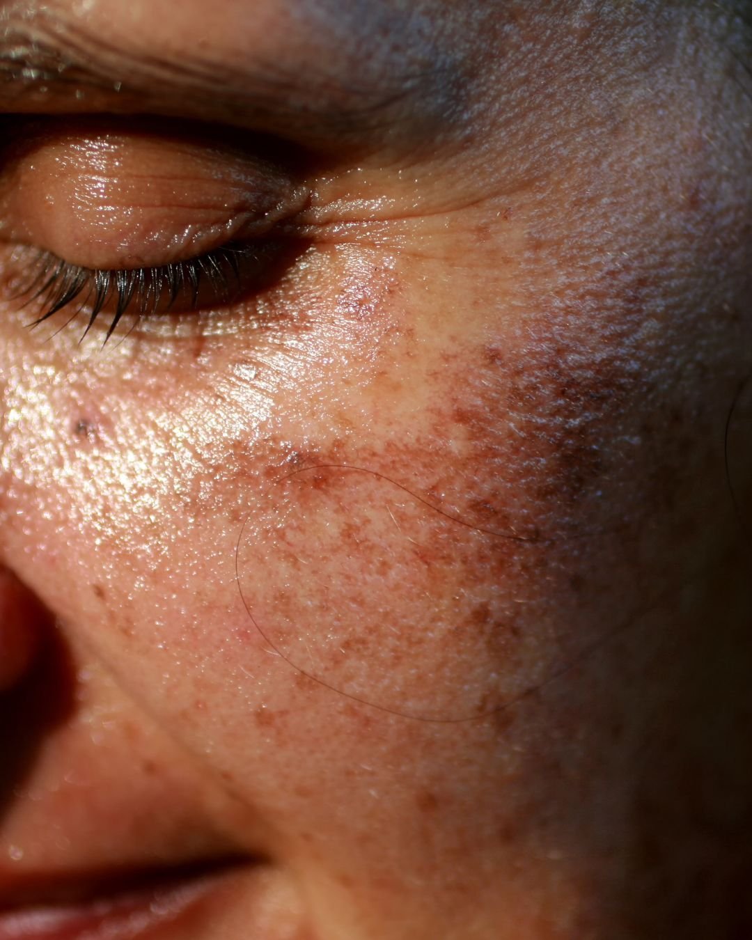 pigmentation laser