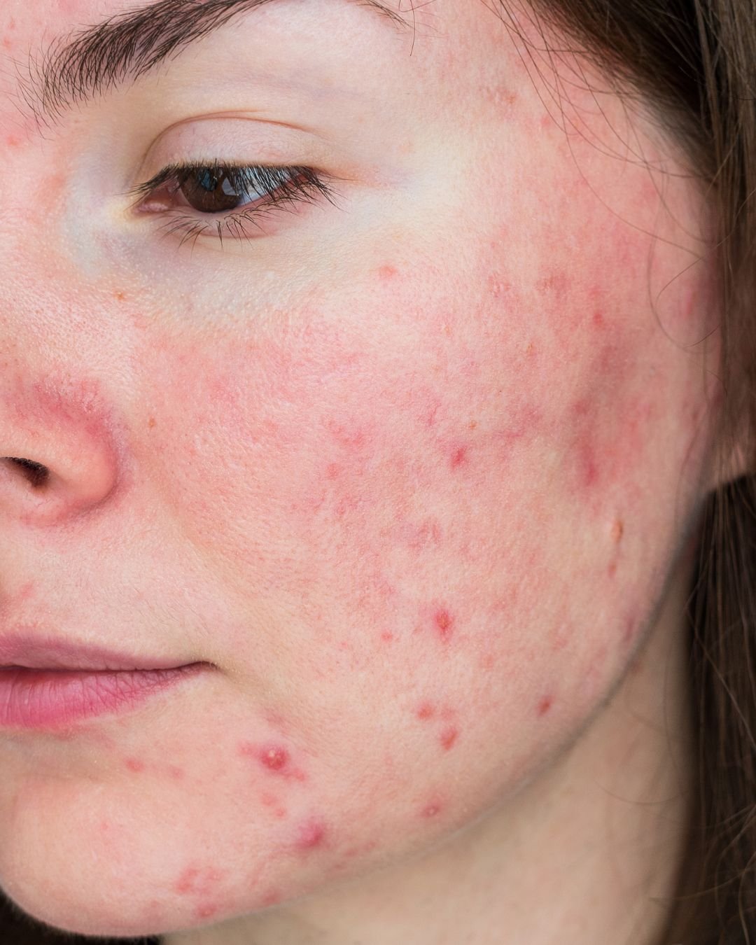 acne laser