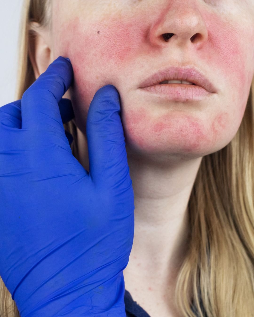 Rosacea