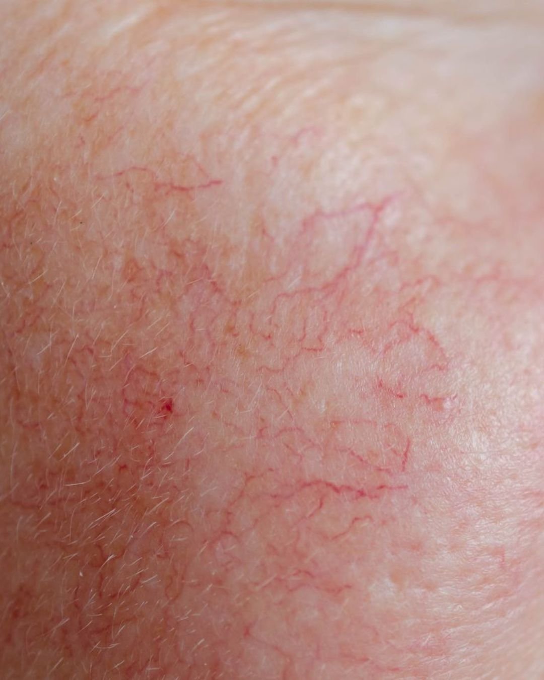 broken blood vessels