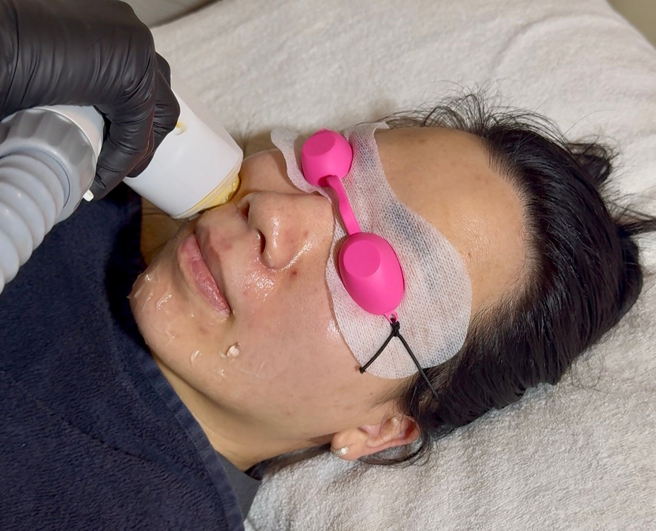 vein removal